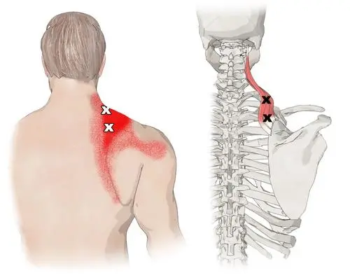 肩胛提肌也会引起颈椎的酸痛症状,常常用脖子和肩膀夹电话,两支手肘架